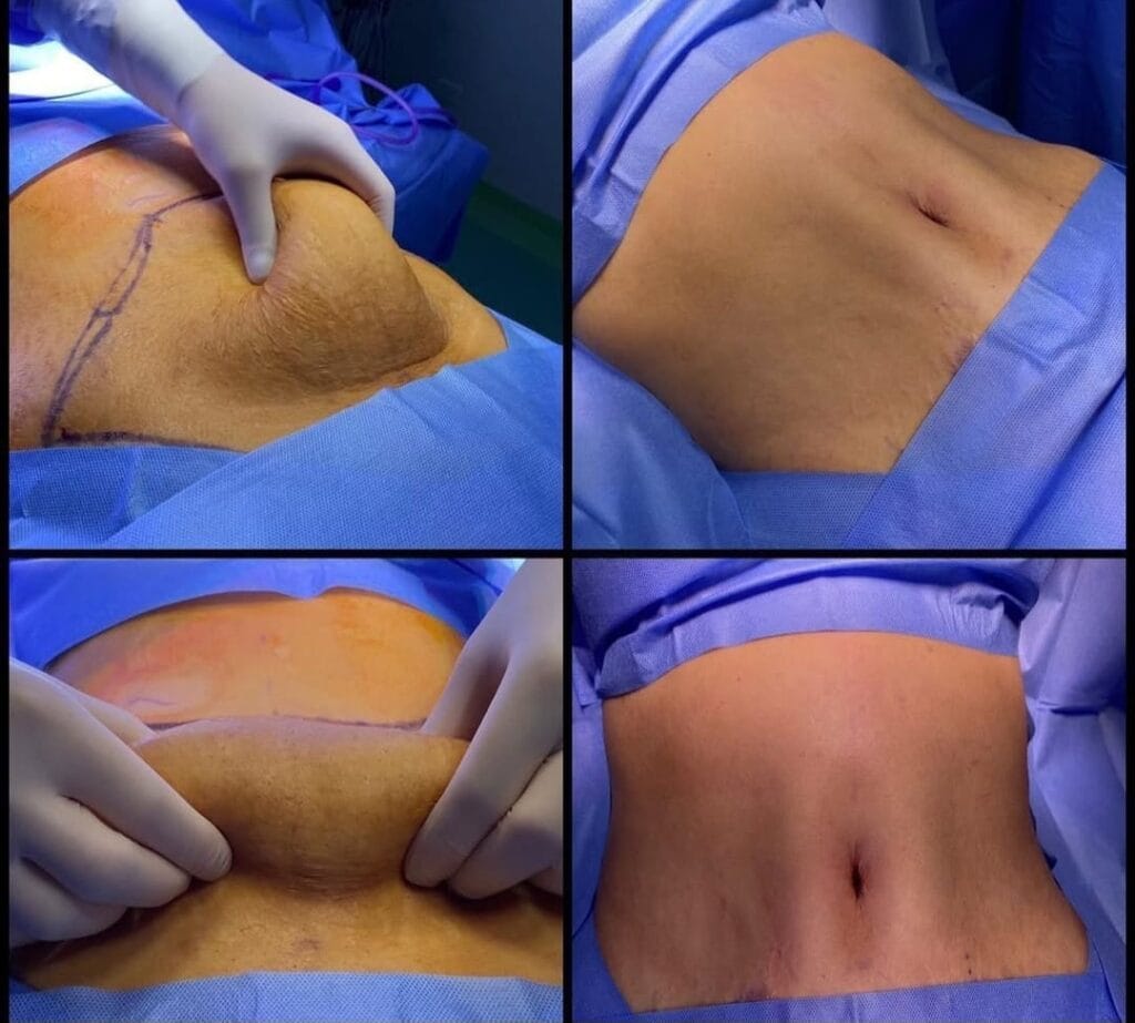 Tummy Tuck before and after