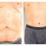 tummy tuck before and after