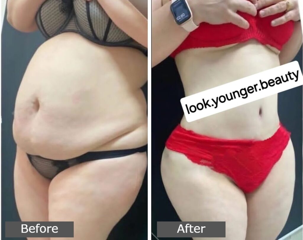 Tummy Tuck