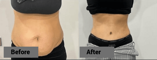 Tummy Tuck