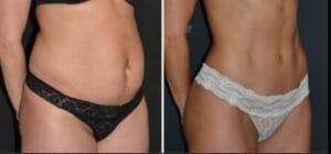 Tummy Tuck