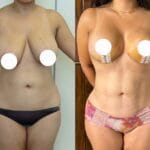 breast lift before and after