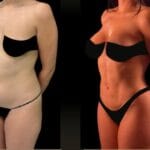 lipo 360 before and after