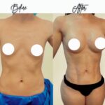 slim lipo before and after