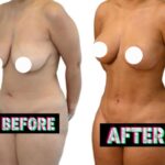 Brest lift before and after