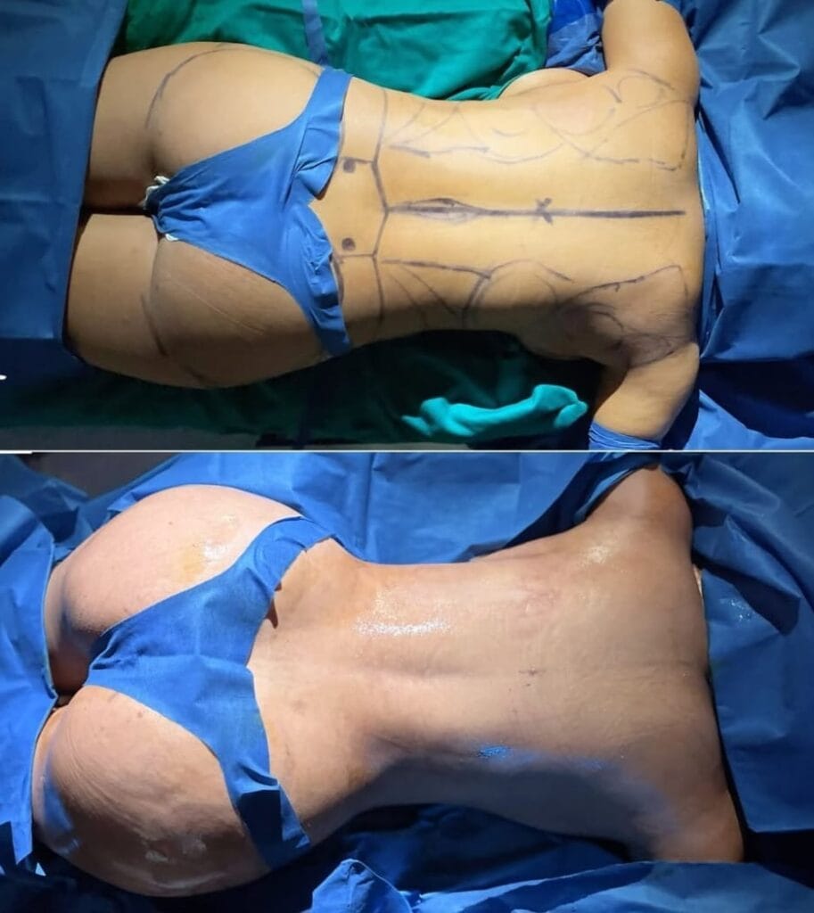 lipo bbl before and after
