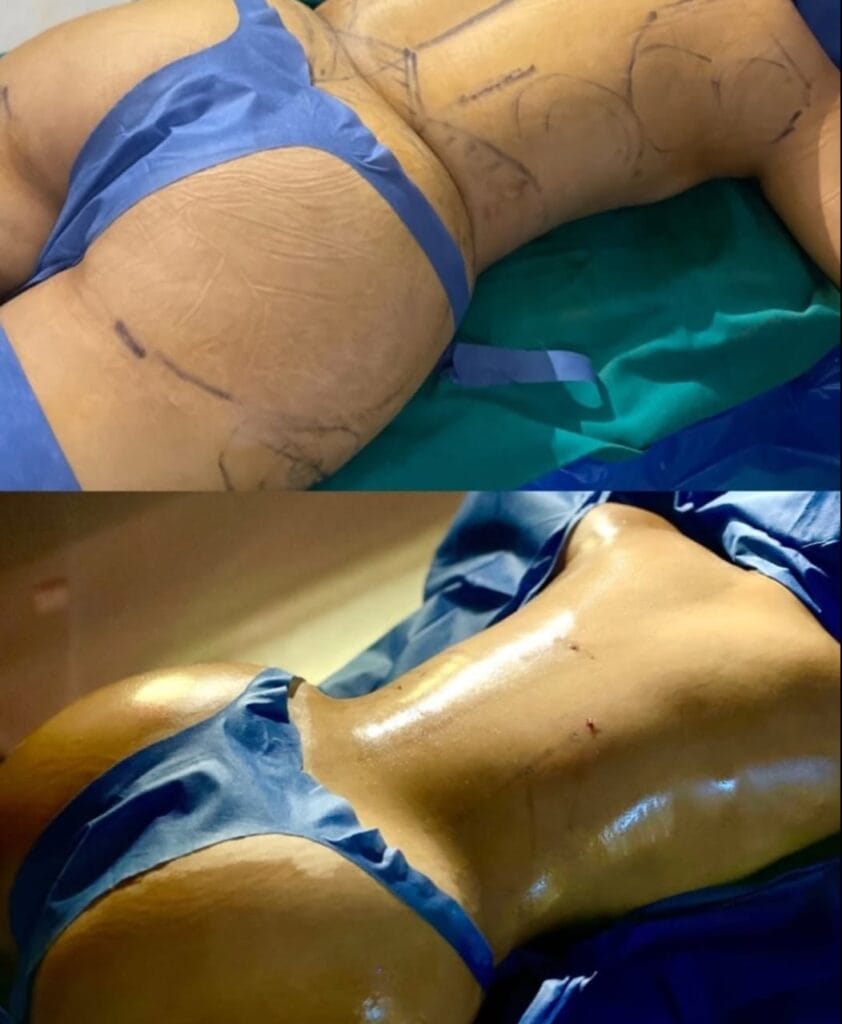 lipo bbl before and after