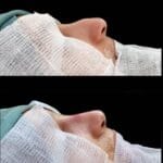 before and after rhinoplasty