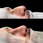 before and after rhinoplasty