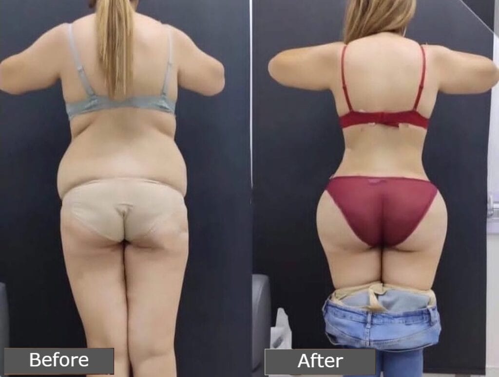 Liposuction