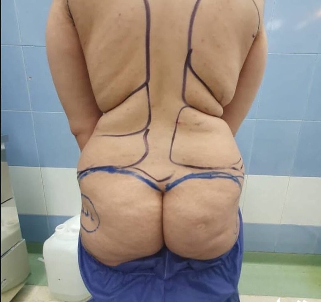 Liposuction