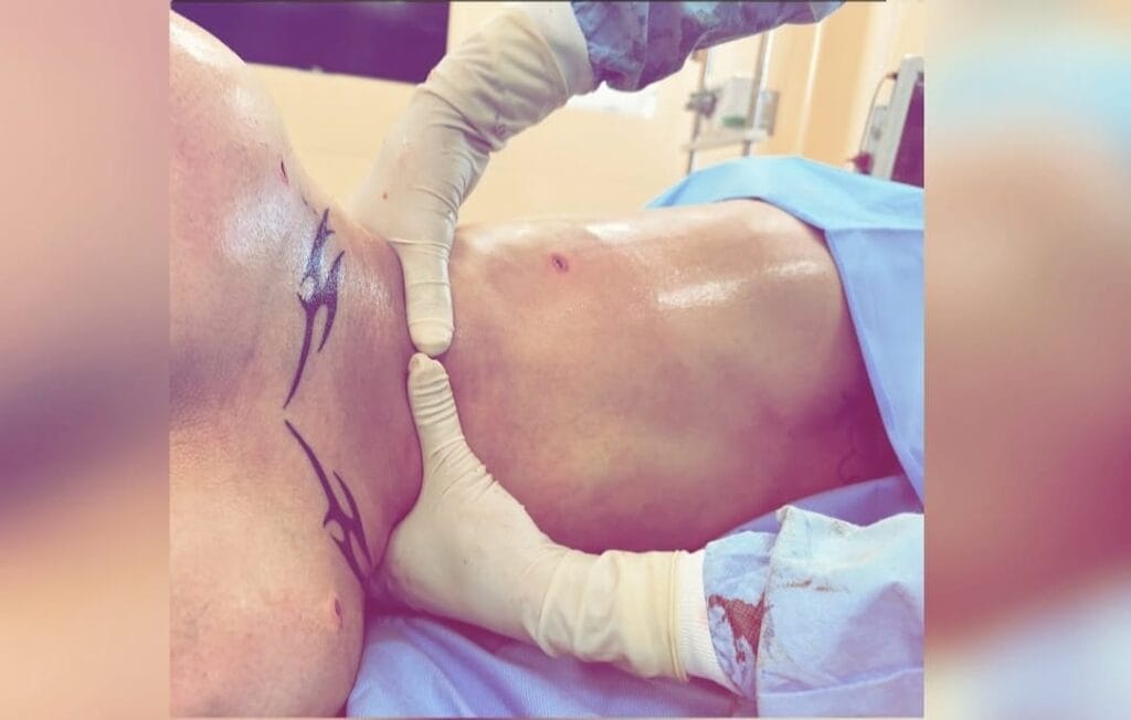 Liposuction