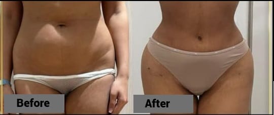 Tummy Tuck
