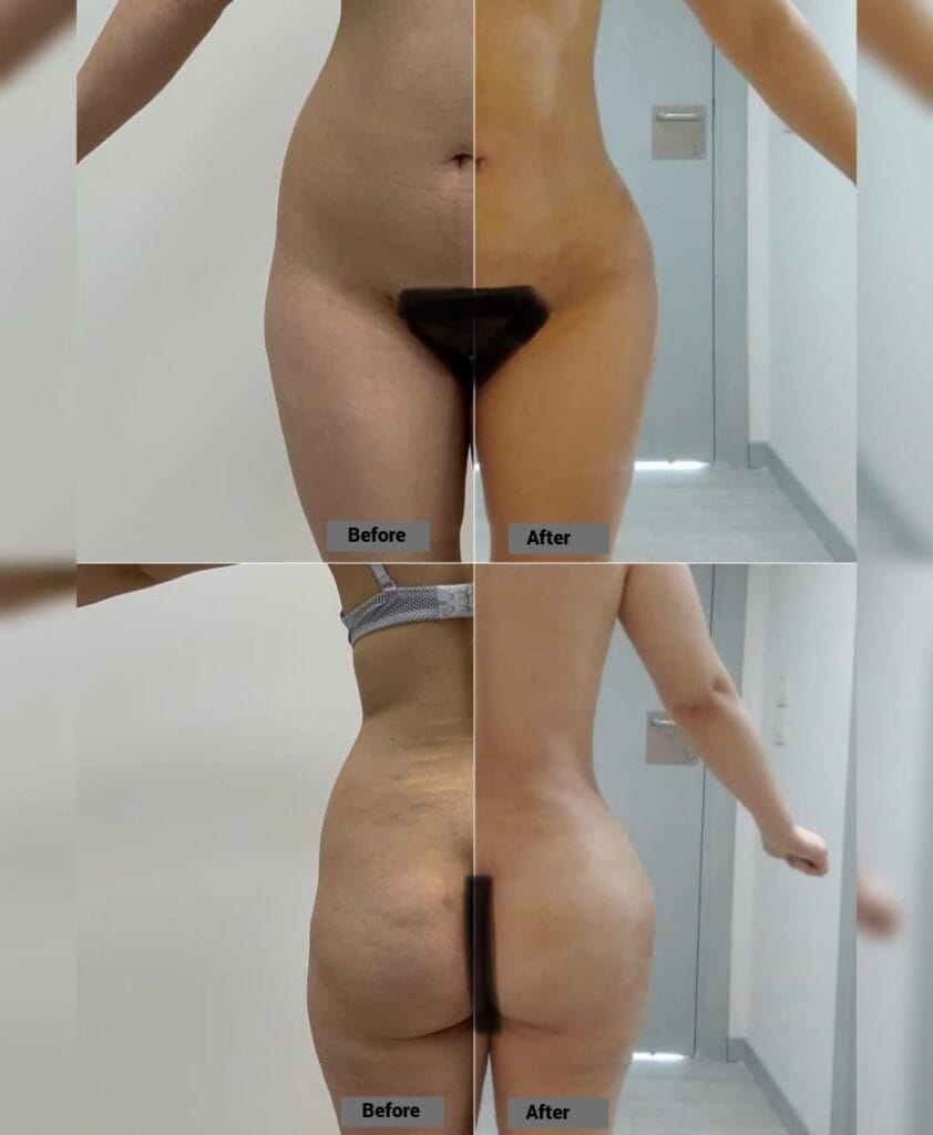 Liposuction