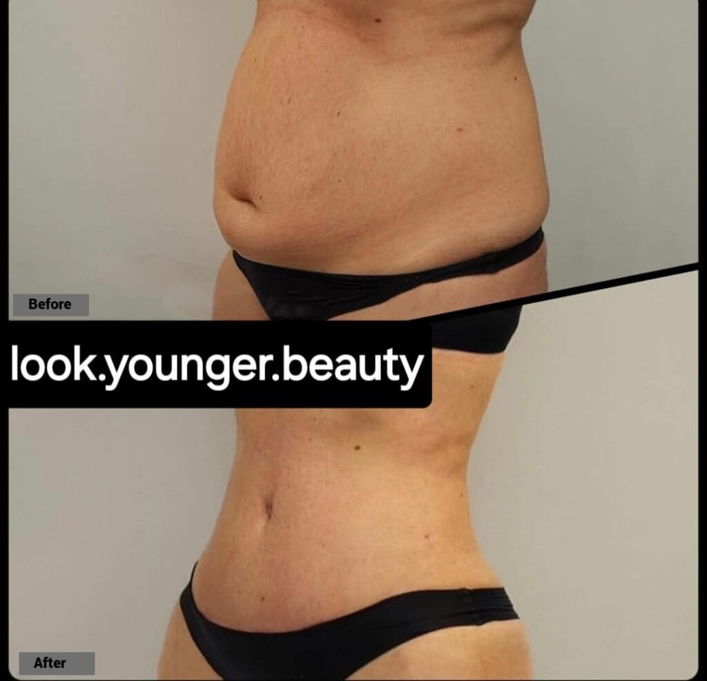 Tummy Tuck