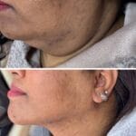 Chin Implant