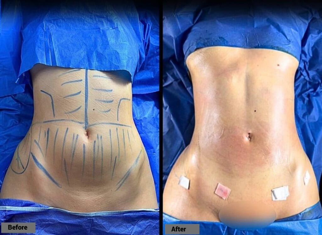 Tummy Tuck