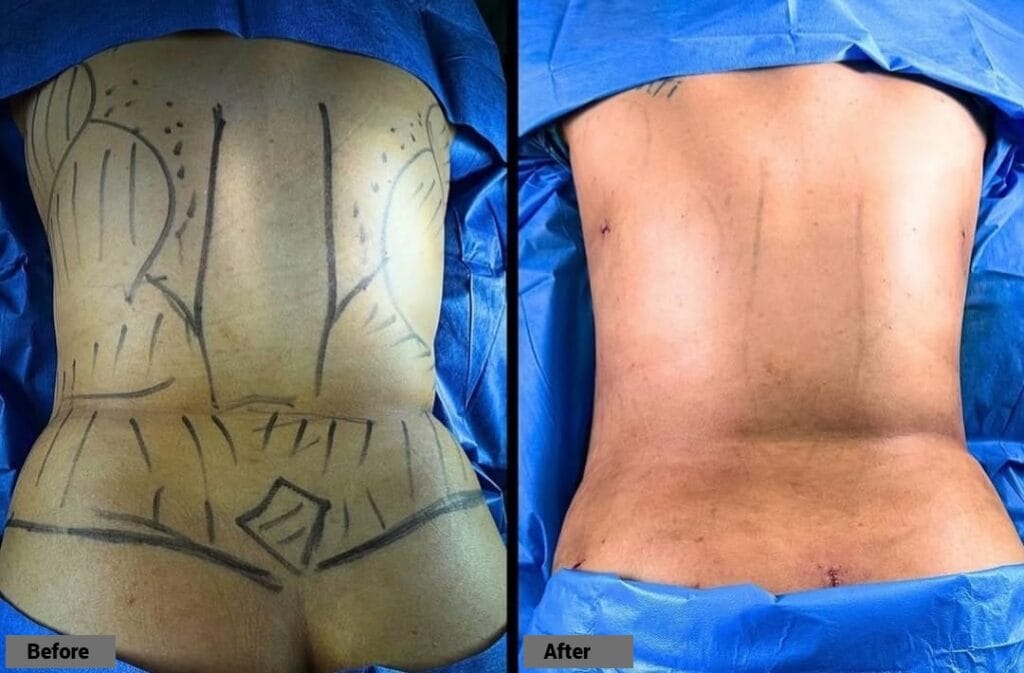 Liposuction