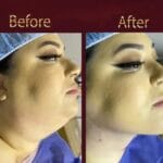 Chin Implant Before&After