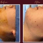 Chin Implant Before&After