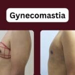 Gynecomastia