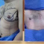 Gynecomastia
