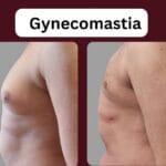 Gynecomastia
