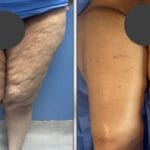 Thigh lift