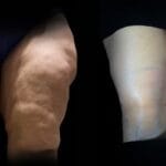Lipo Thighs