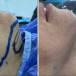 Chin Implant Before&After