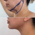 Chin Implant Before&After