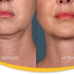 Chin Implant Before&After