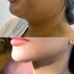 Chin Implant Before&After