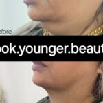 Chin Implant Before&After