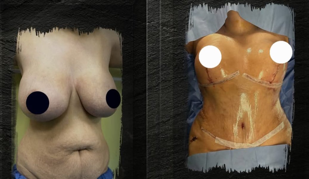 Before After Surgery