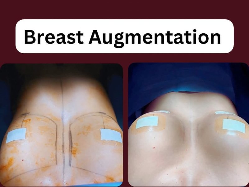 Breast Augmentation