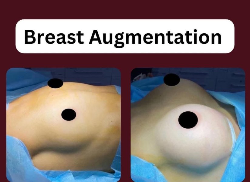 Breast Augmentation