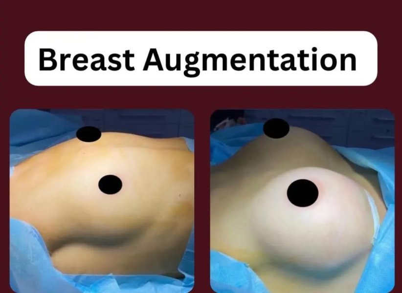 Breast Augmentation