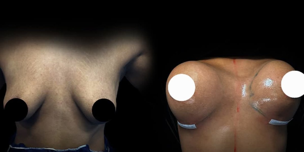 Breast Augmentation