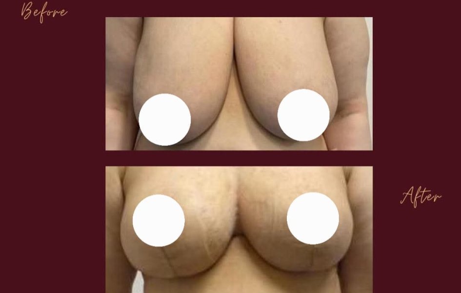 Breast Augmentation Results