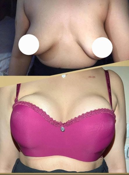 Breast Augmentation Results