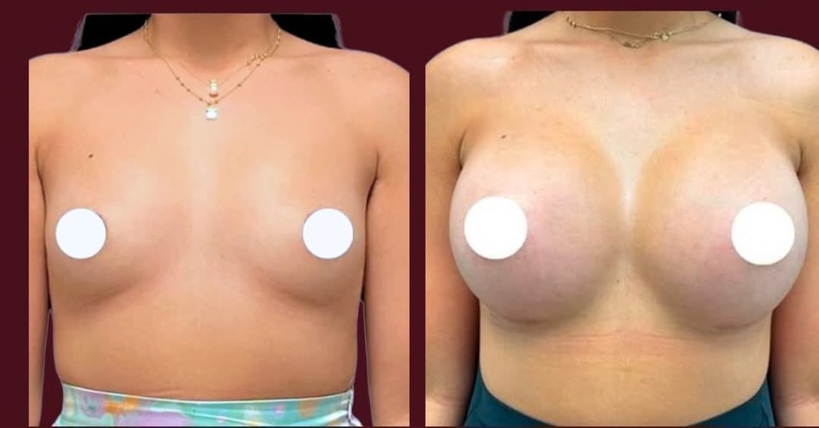 Breast Augmentation Surgery