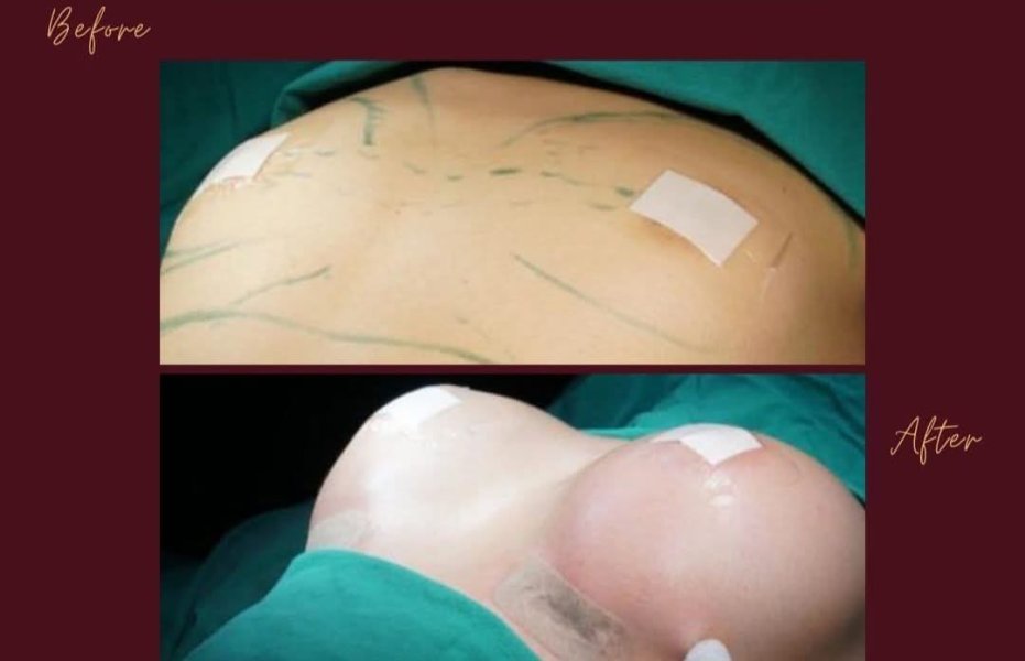Breast Augmentation Surgery