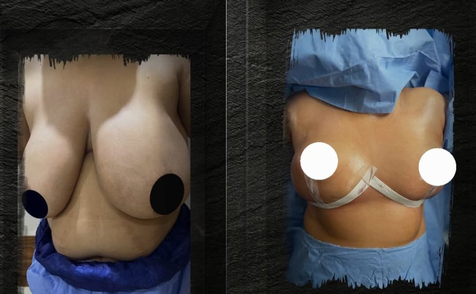 Breast Augmentation Surgery