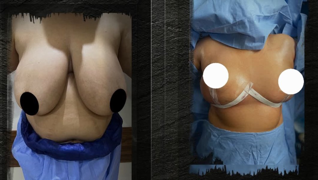 Breast Augmentation Surgery