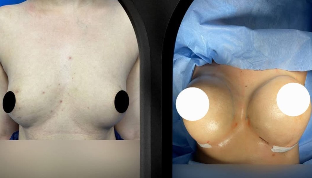 Breast Implants Surgery