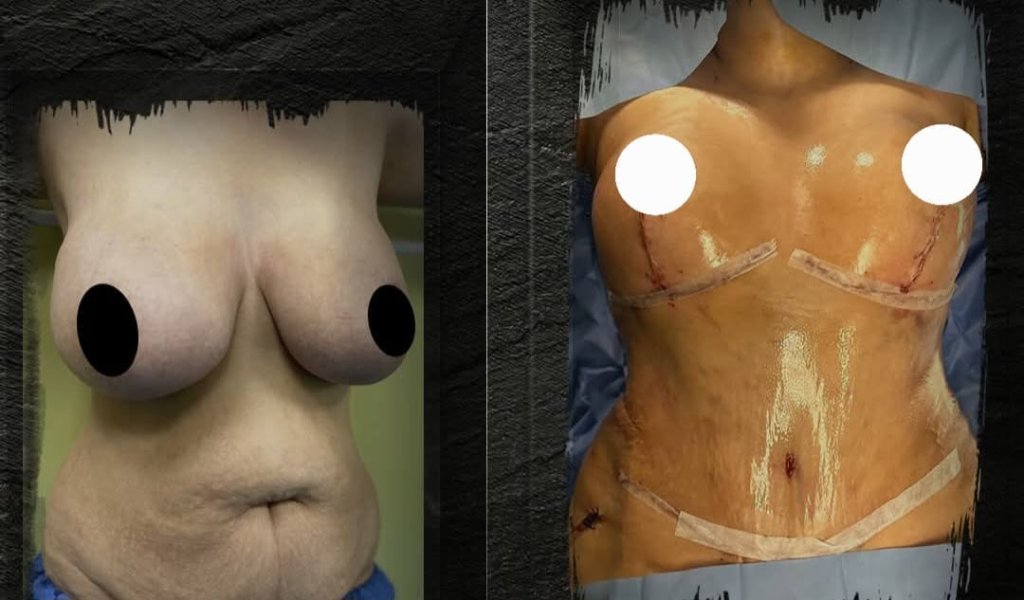 Breast Reconstruction Surgery