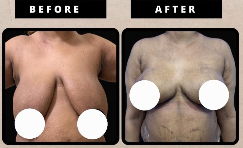 Breast Reduction Surgery