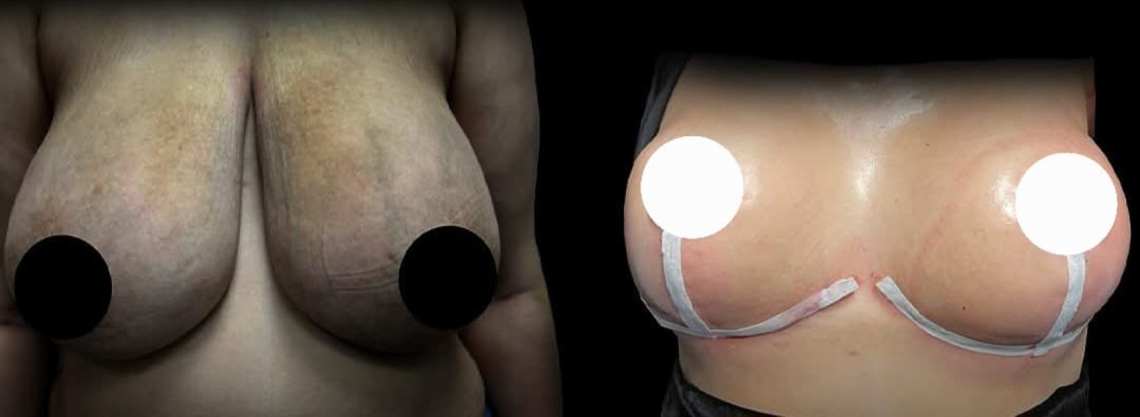 Breast Reduction Surgery