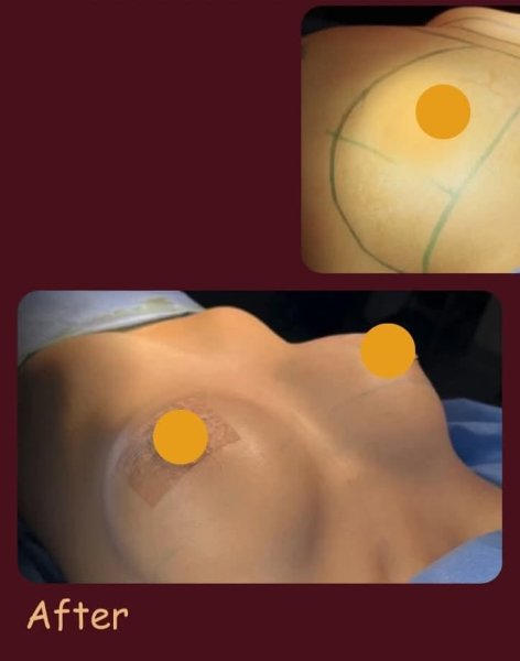 Breast Surgery After